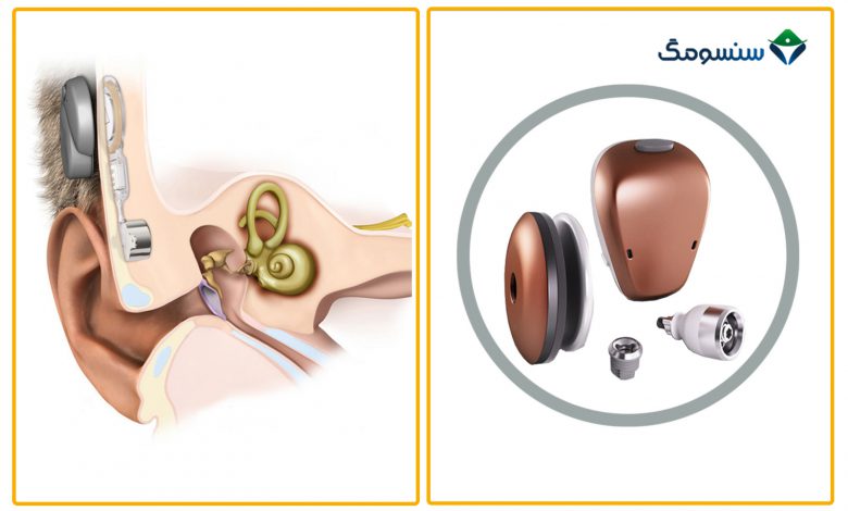 دستگاه‌های شنوایی انتقال استخوانی